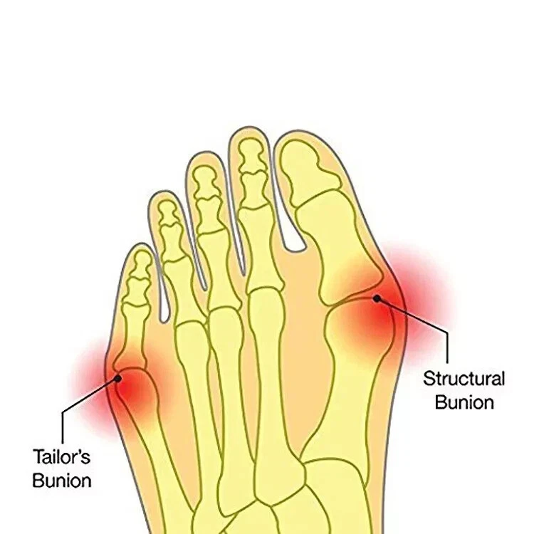 Bunion corrector sleeve best product in uk