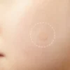 pimple stickers uk