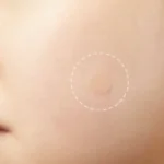 pimple stickers uk